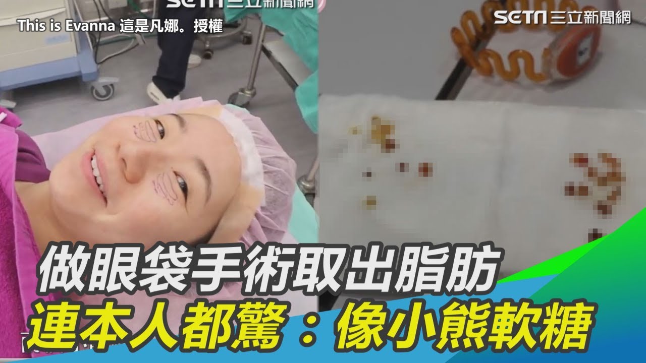 做眼袋手術取出脂肪　連本人都驚：好像小熊軟糖｜三立新聞網SETN.com
