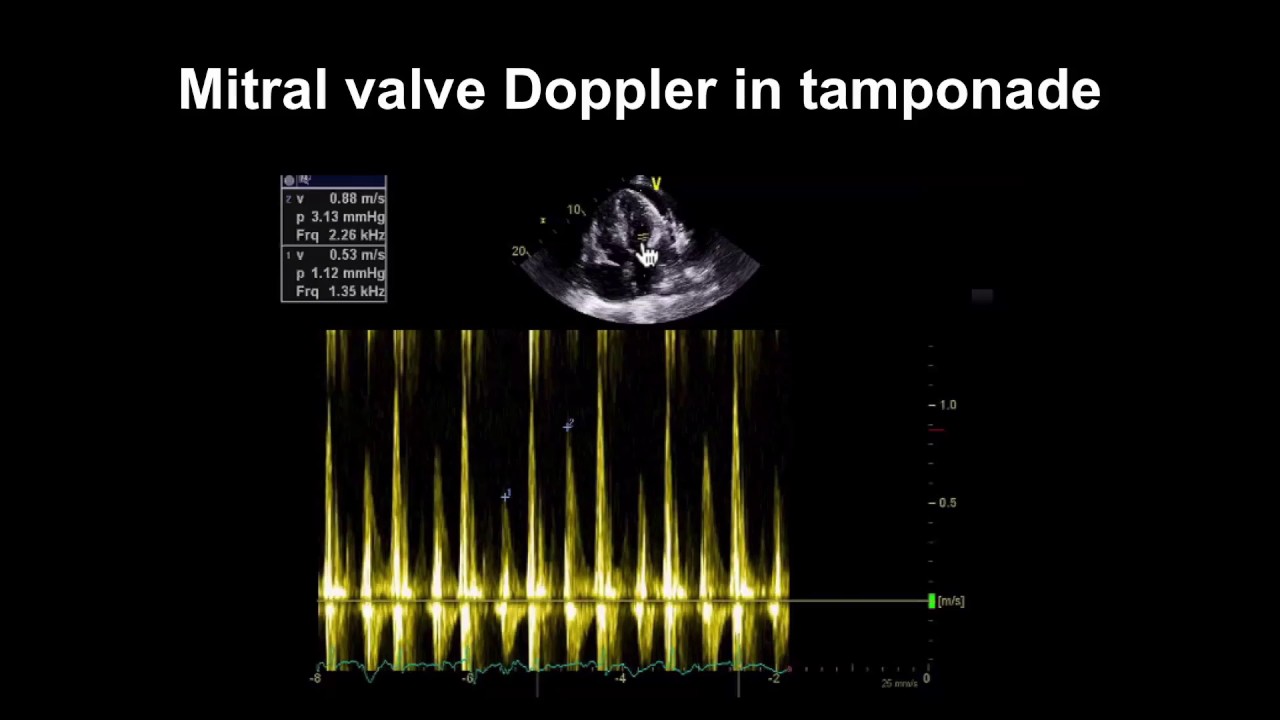 Echocardiography Essentials: Detecting pericardial effusions