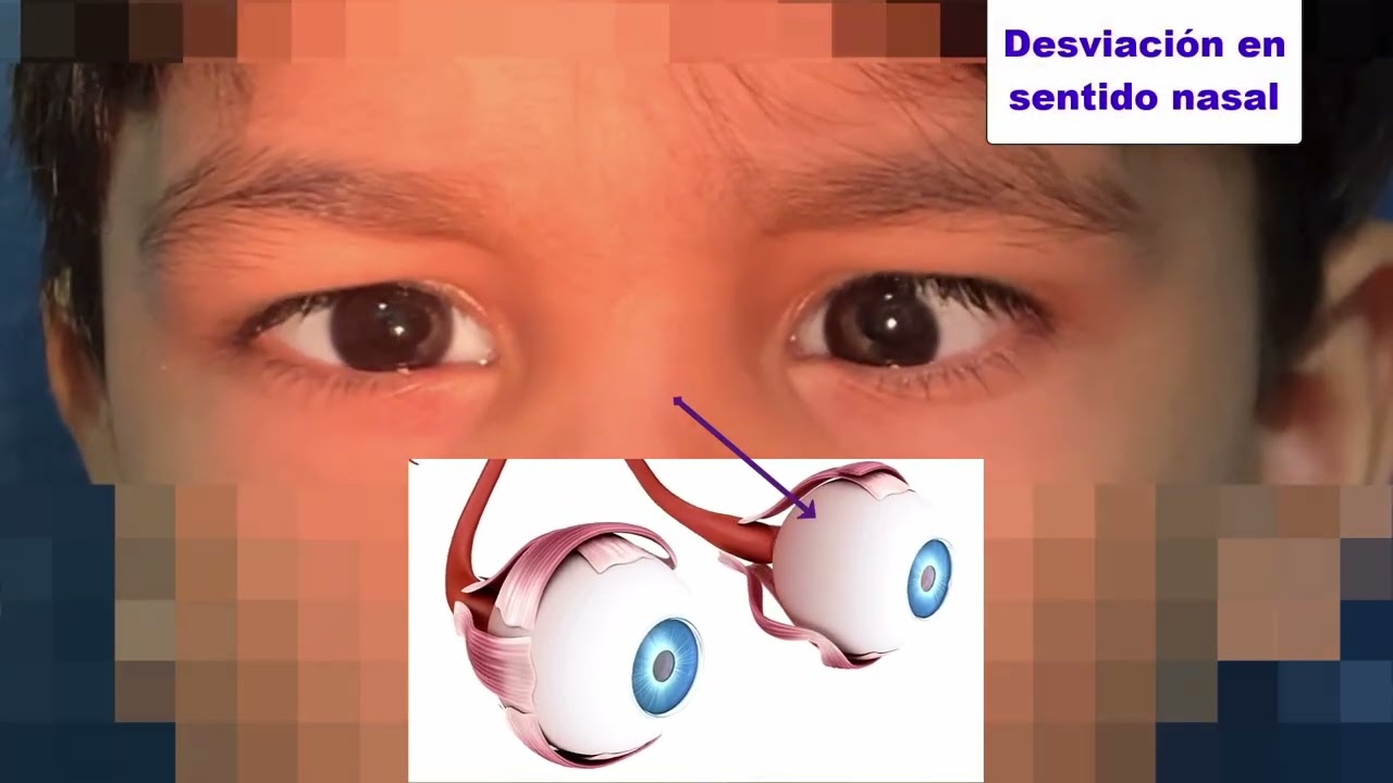 Uso de lentes con prismas  para estrabismo u ojo bizco,