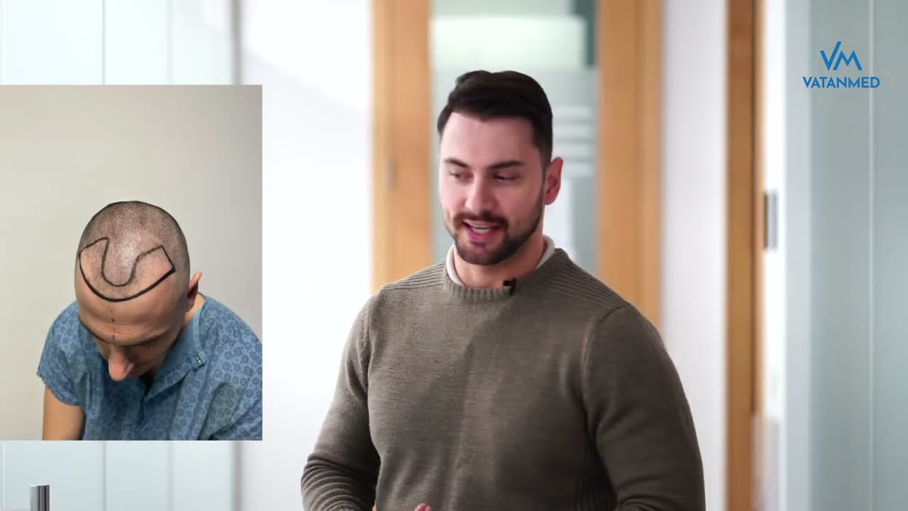 ''My life changed after hair transplant'' -VATANMED