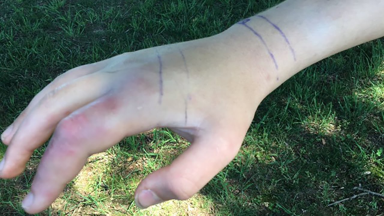 MUST SEE: Copperhead snake bites Concord teen