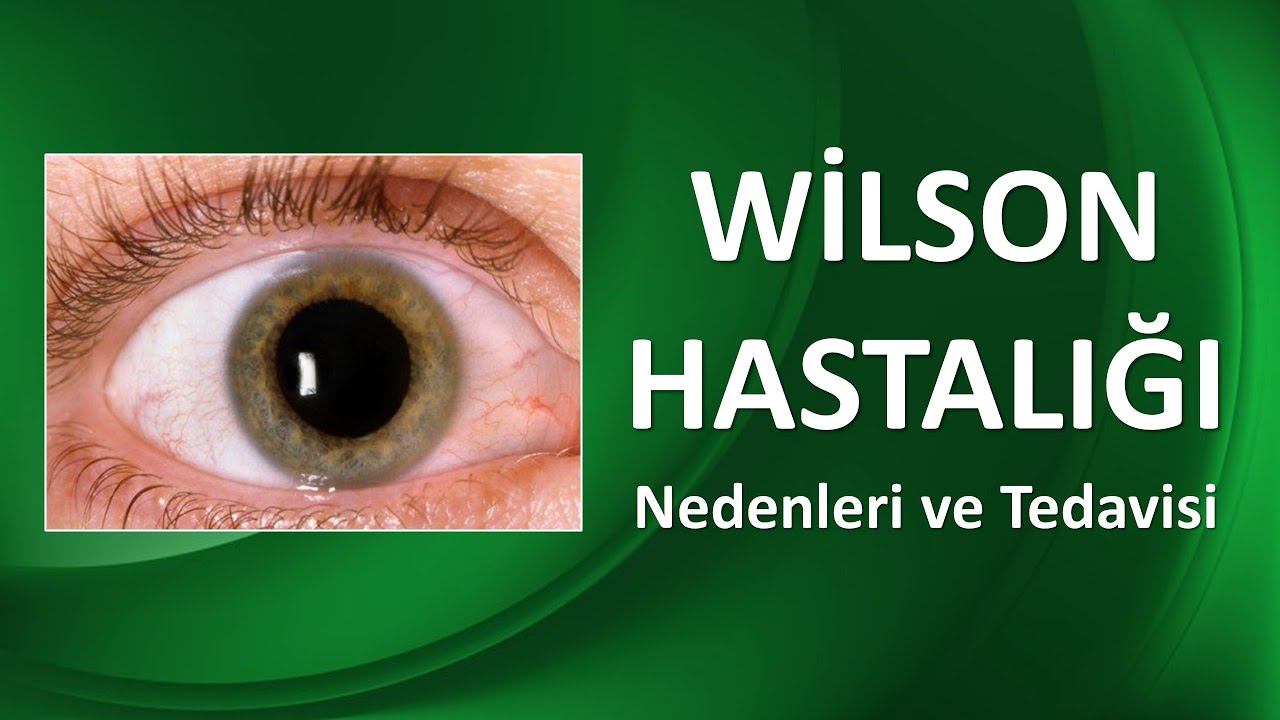 WİLSON HASTALIĞI NEDİR? NASIL TEDAVİ EDİLİR?