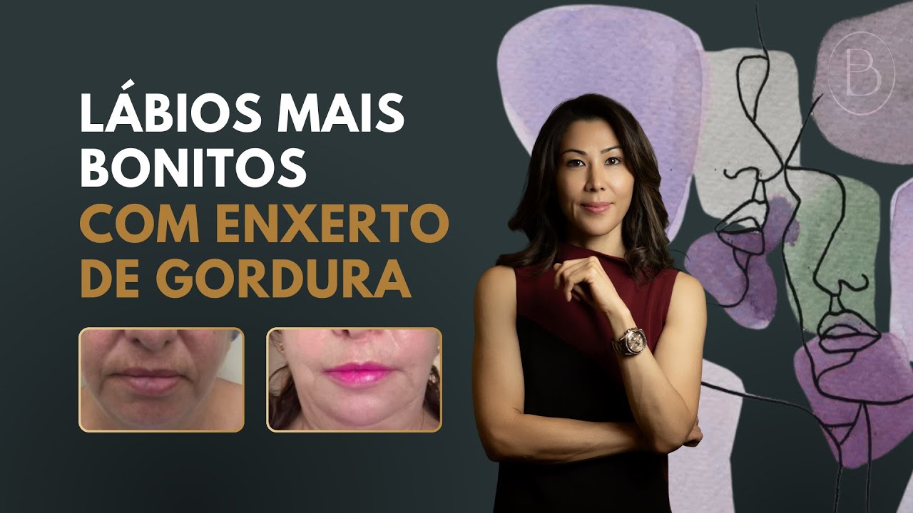 Lip Lift: porque s&oacute; indico para pacientes mais velhas!