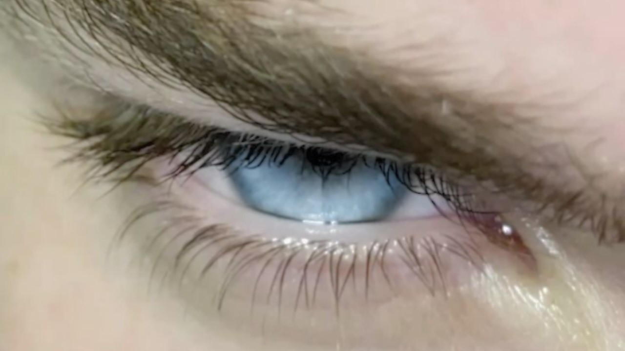 eye melanin remover