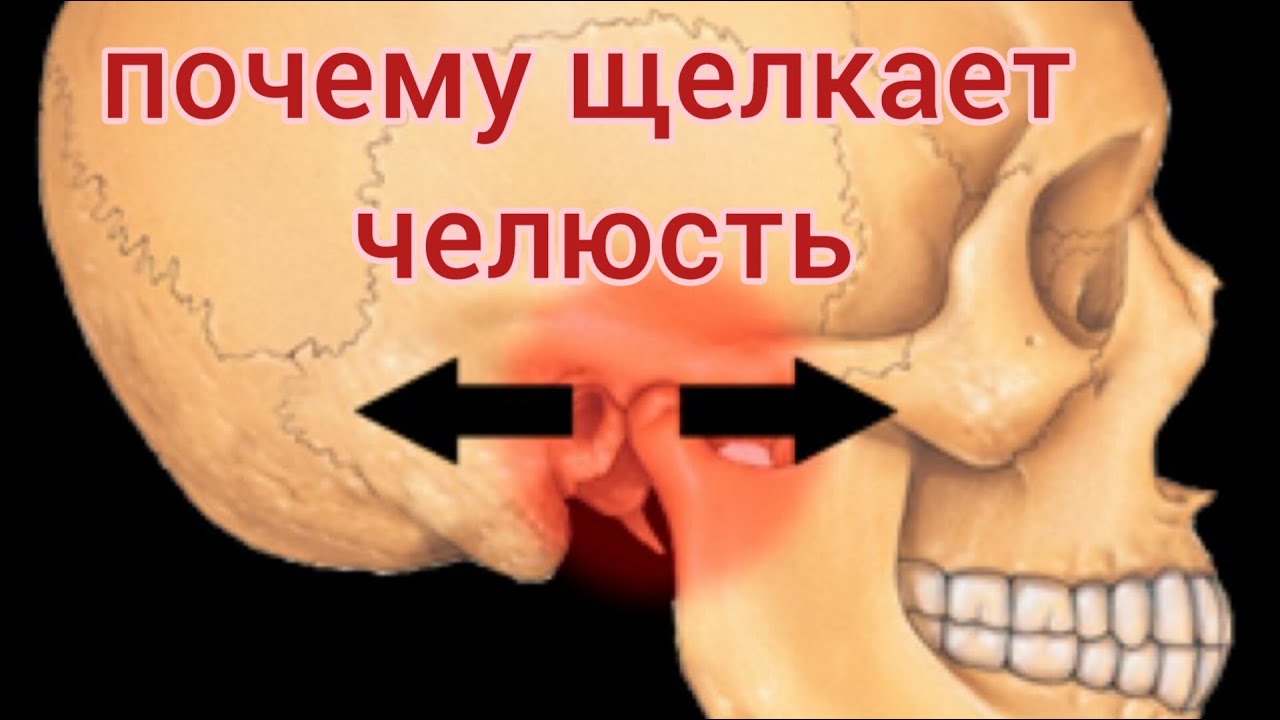 Что делать если ЧЕЛЮСТЬ щелкает? ЩЕЛЧКИ в челюсти при открывании рта. Почему ЩЕЛКАЕТ челюсть?