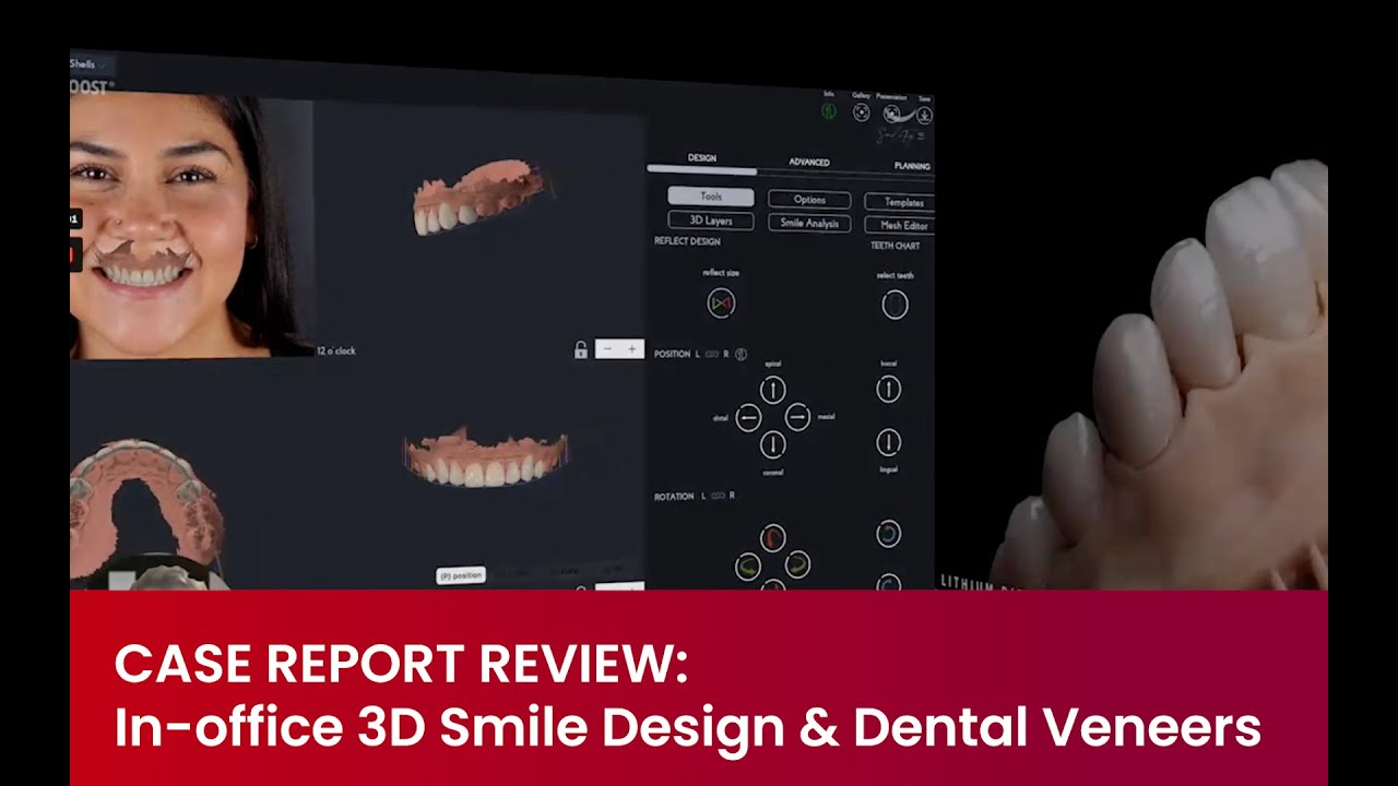 CASE REPORT REVIEW: In-office 3D Smile Design & Dental Veneers