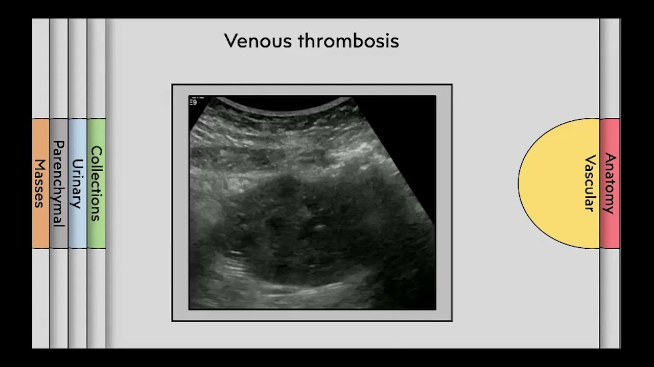Imaging of kidney transplant