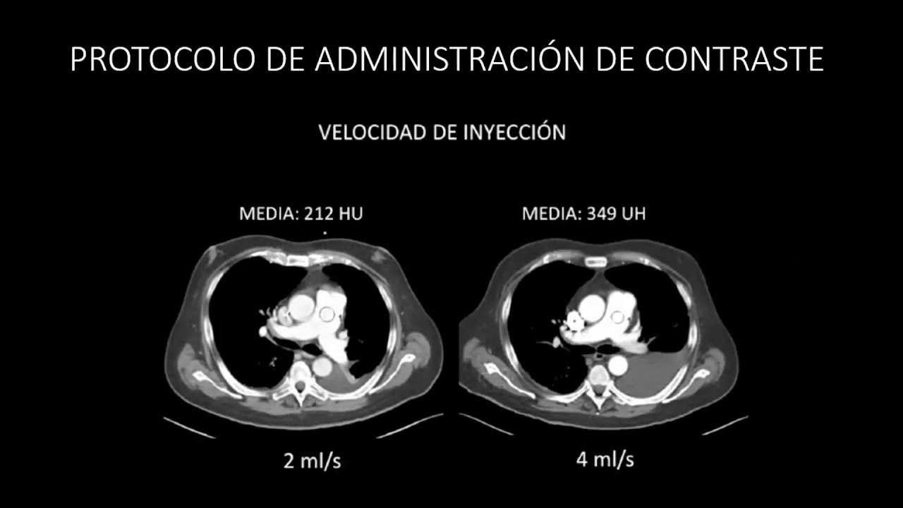 Tromboembolia Pulmonar