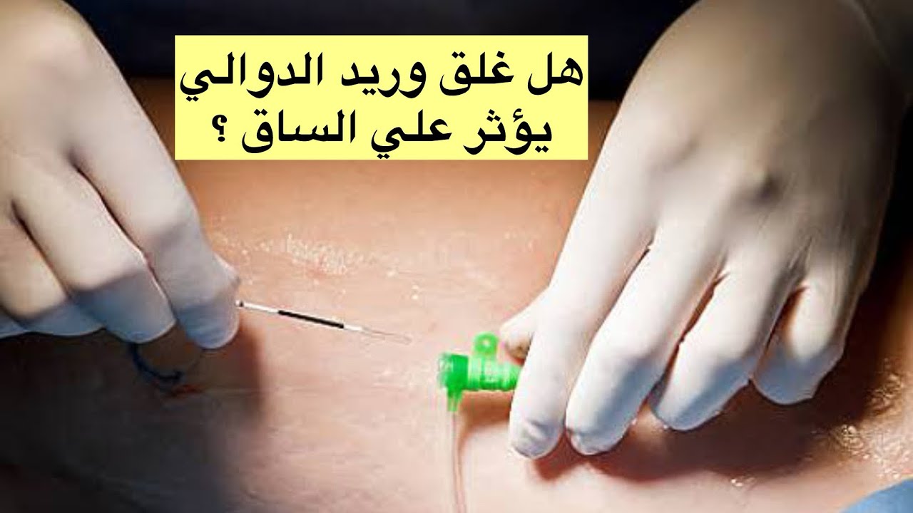 هل كي و غلق وريد الدوالي بالليزر يؤثر علي الساق و رجوع الدم الي القلب | د. مصطفى فريد