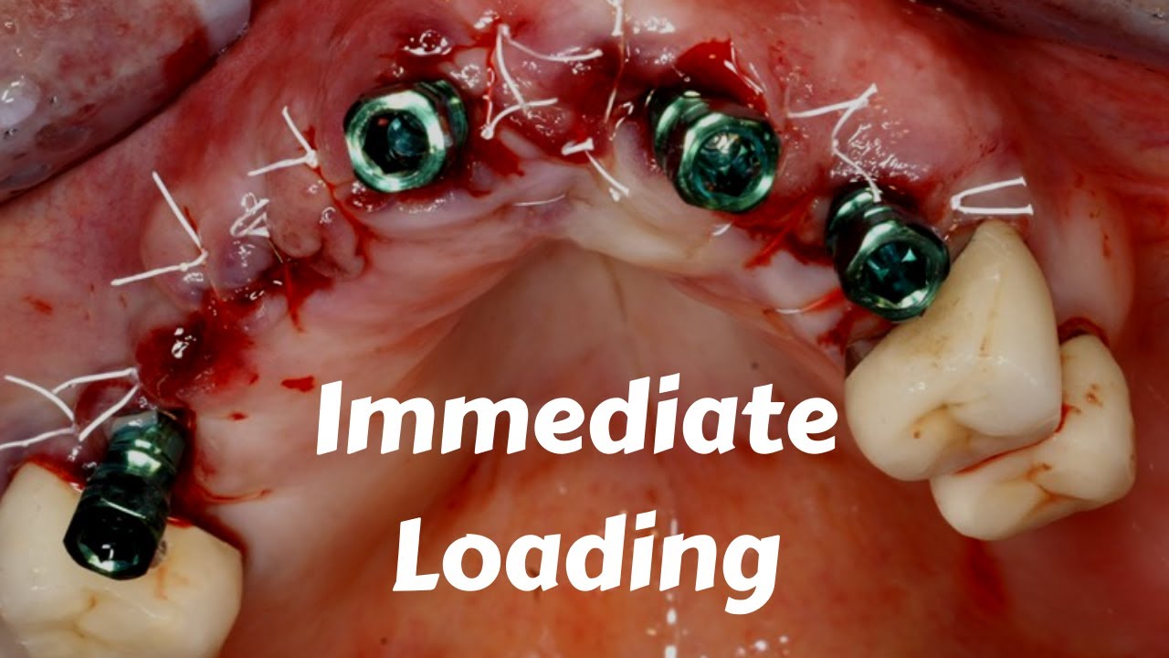 Immediate Loading Dental Implants Protocol- Advantage & Disadvantages in Edentulous -Implant Course