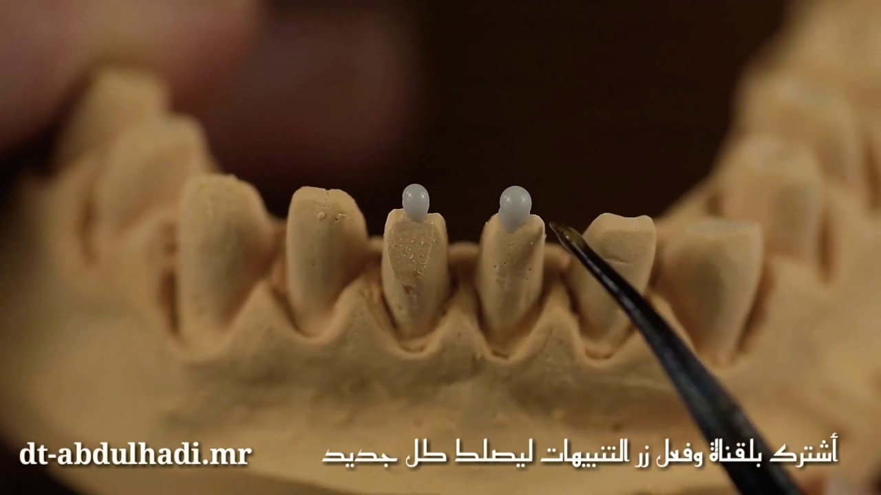 تشميع الثنايا السفلية   wax up