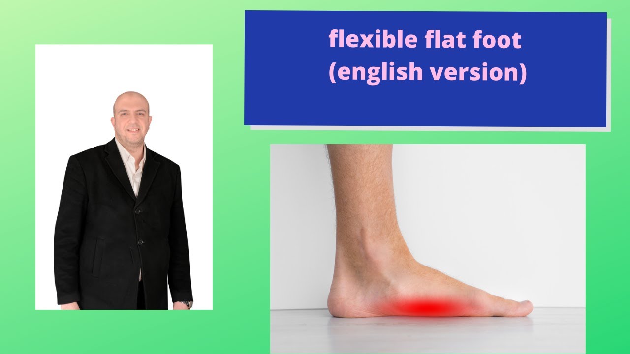 flexible flat foot (english version)