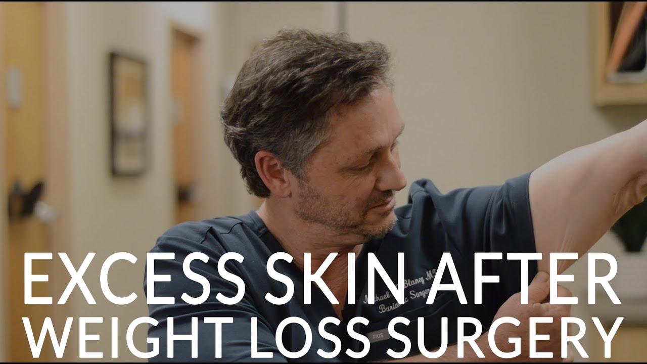 EXCESS SKIN AFTER BARIATRIC SURGERY | How to Handle Loose Skin after Extreme Weight Loss