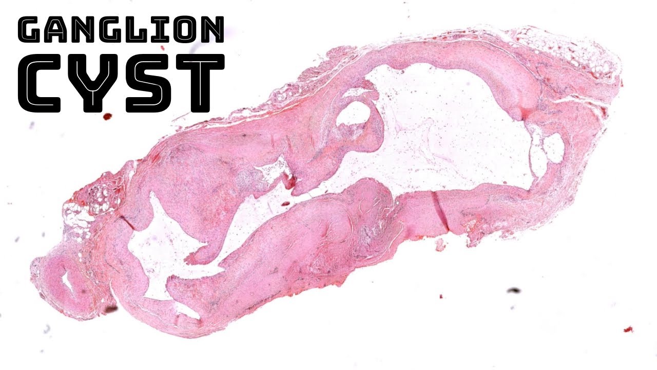 Ganglion cyst under the microscope (synovial cyst; Baker's cyst) pathology dermpath dermatology