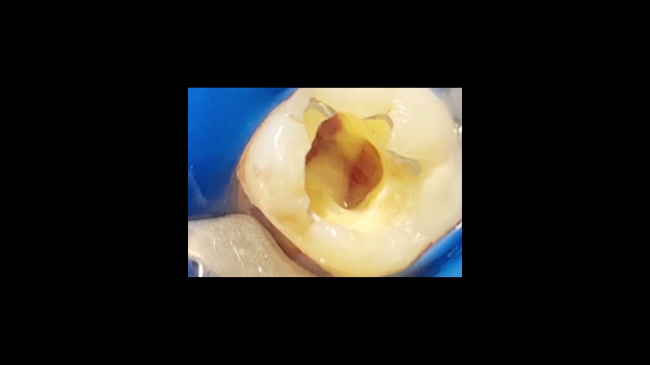 ازاى وامتى تعمل MTA Pulpotomy of mature teeth
