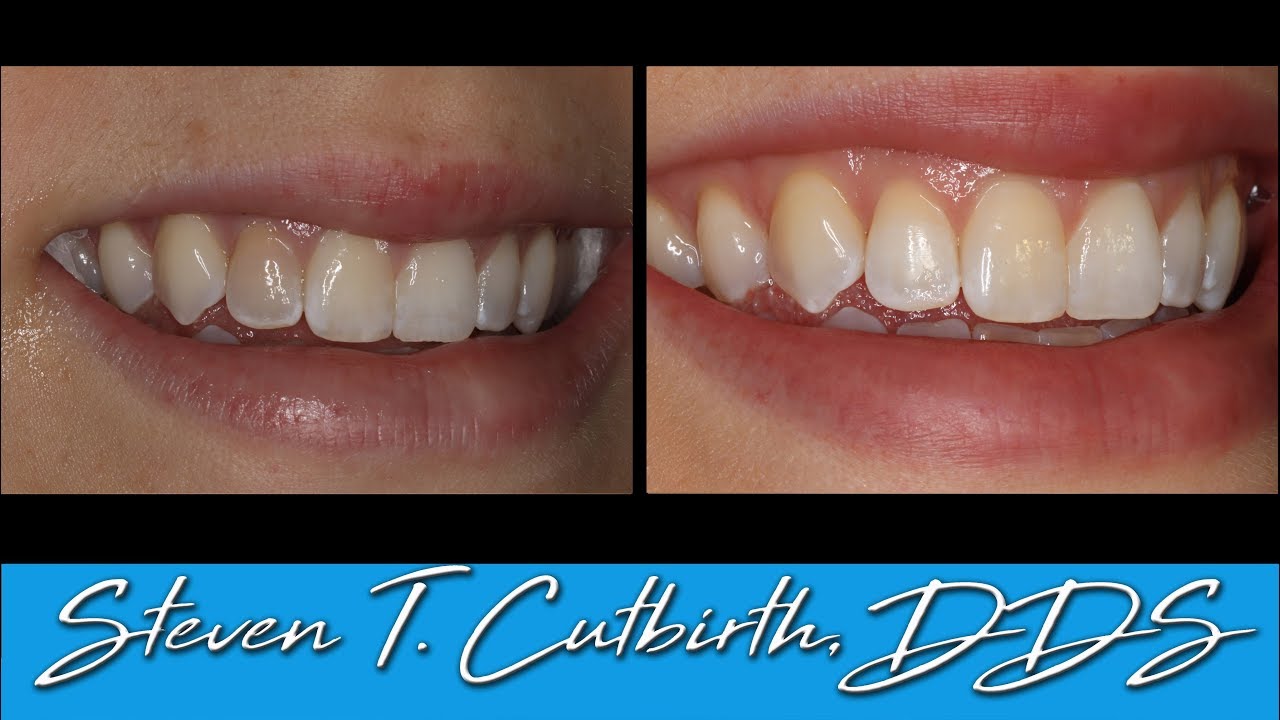 Internal Bleaching of a Dark Tooth - Dental Minute with Steven T. Cutbirth, DDS