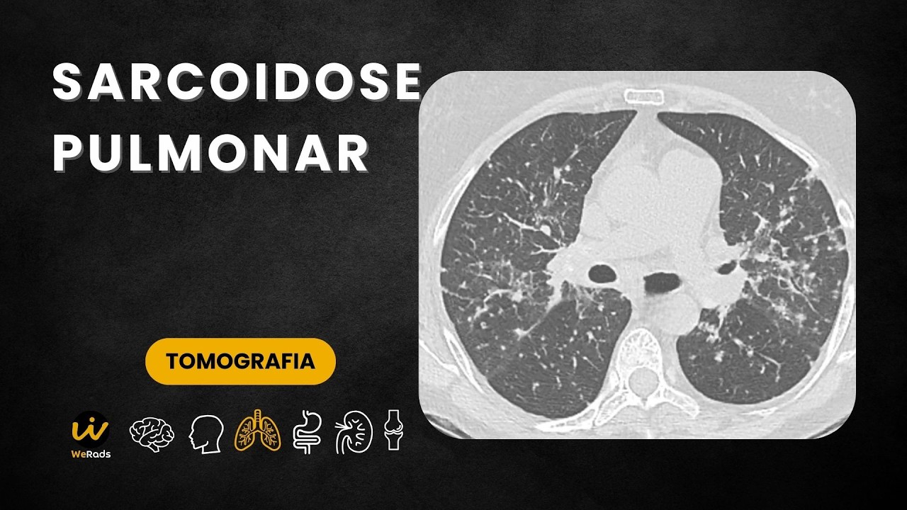 SARCOIDOSE PULMONAR