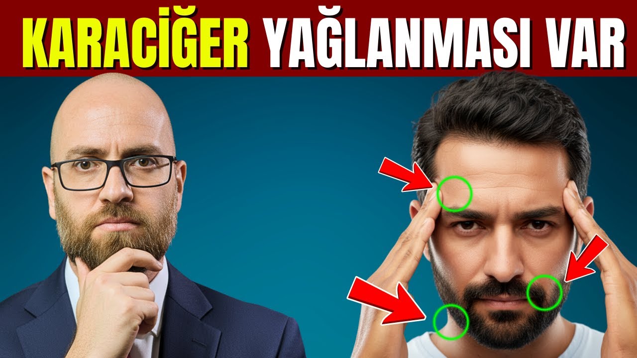 Karaciğer Yağlanması Olan Herkesin Ortak Bir Özelliği Var – Sessiz Bir Uyarı