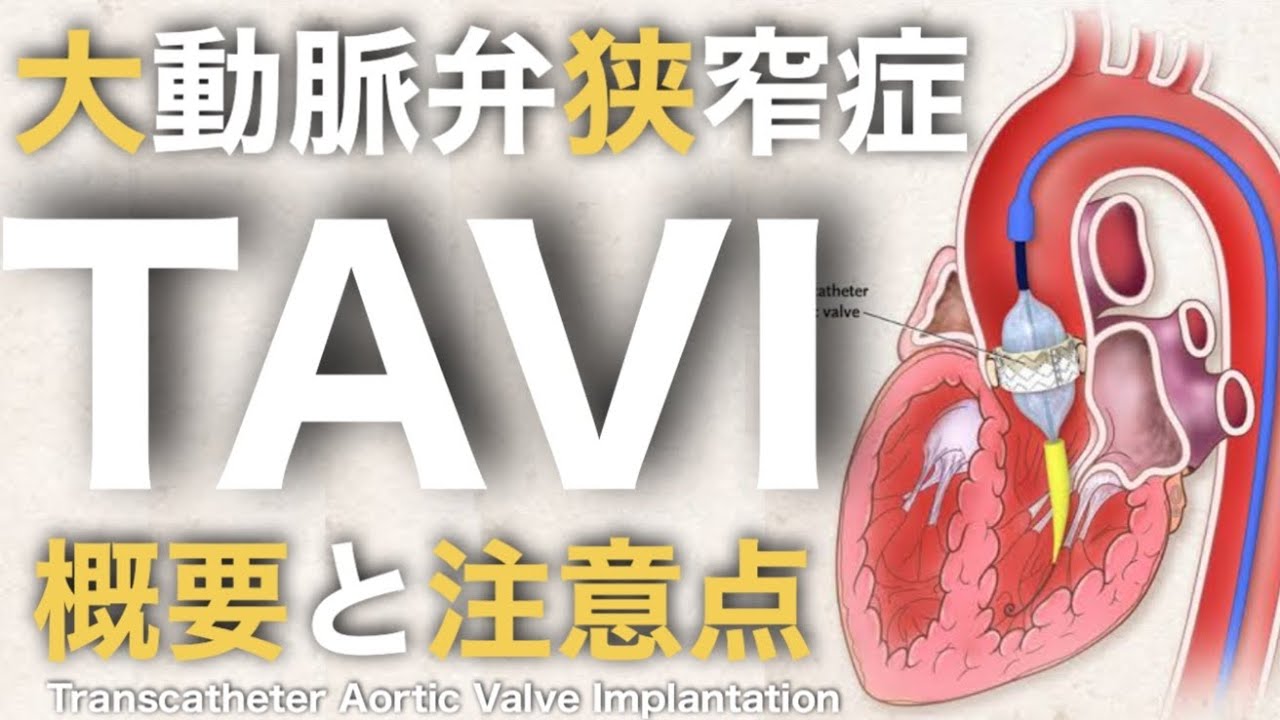 大動脈弁狭窄症に対するTAVI（タビ）の概要と看護について