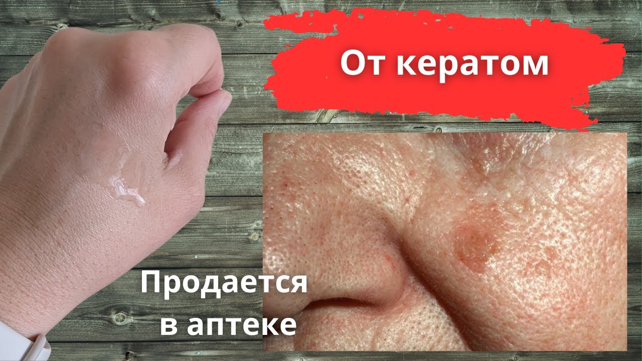 Легко и безопасно убрать кератомы без рубцов и шрамов