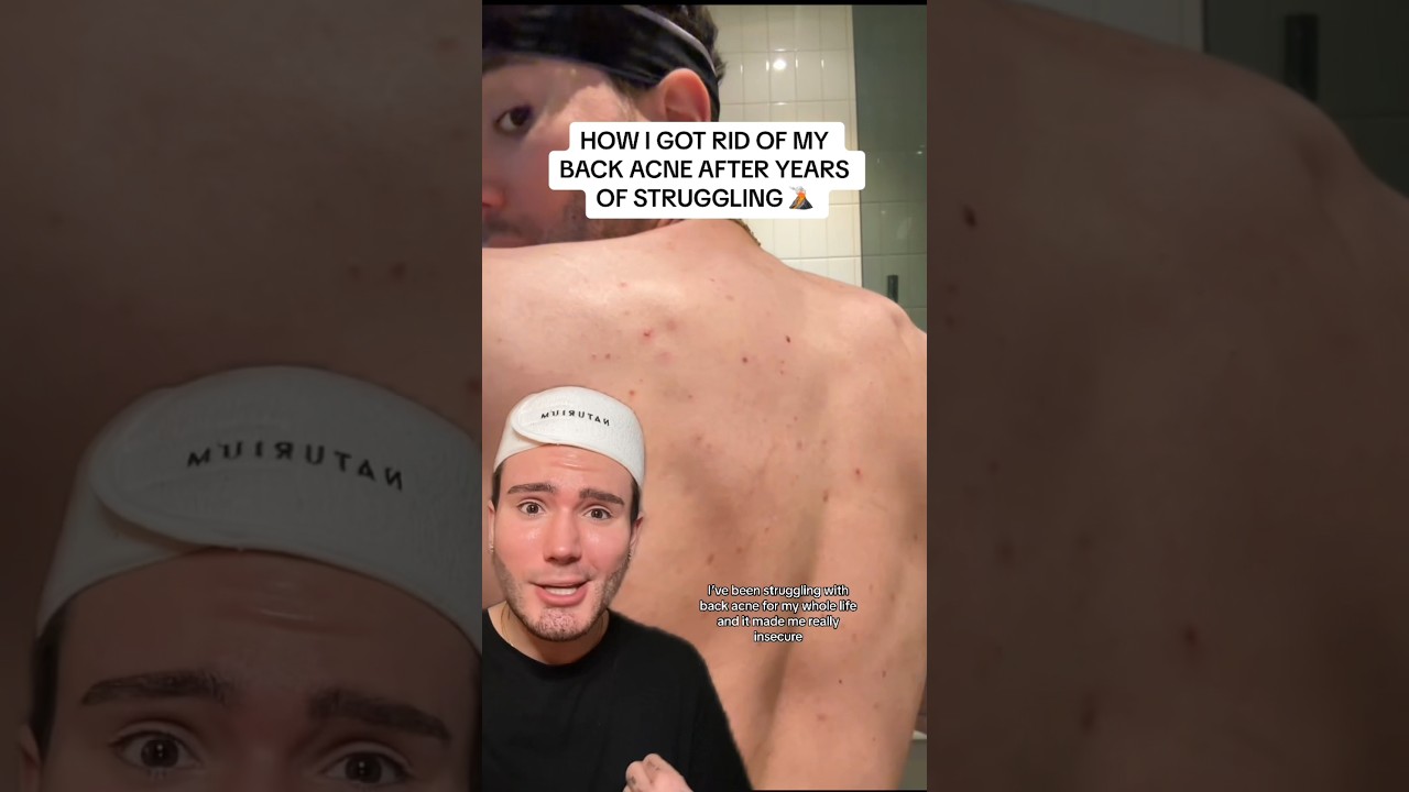 HOW TO GET RID OF BACK ACNE!🌋 (follow for more!💗) #acne #skincare #skincareroutine #skin #beauty