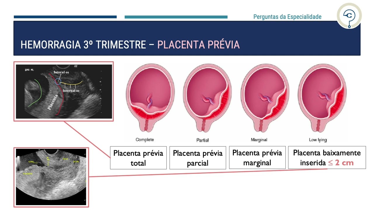 V&iacute;deo por patologia - Hemorragia 3&ordm; trimestre