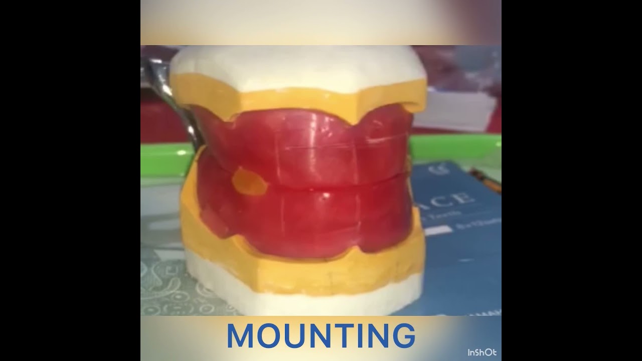 COMPLETE DENTURE: MASTER CAST TO FESTOONING