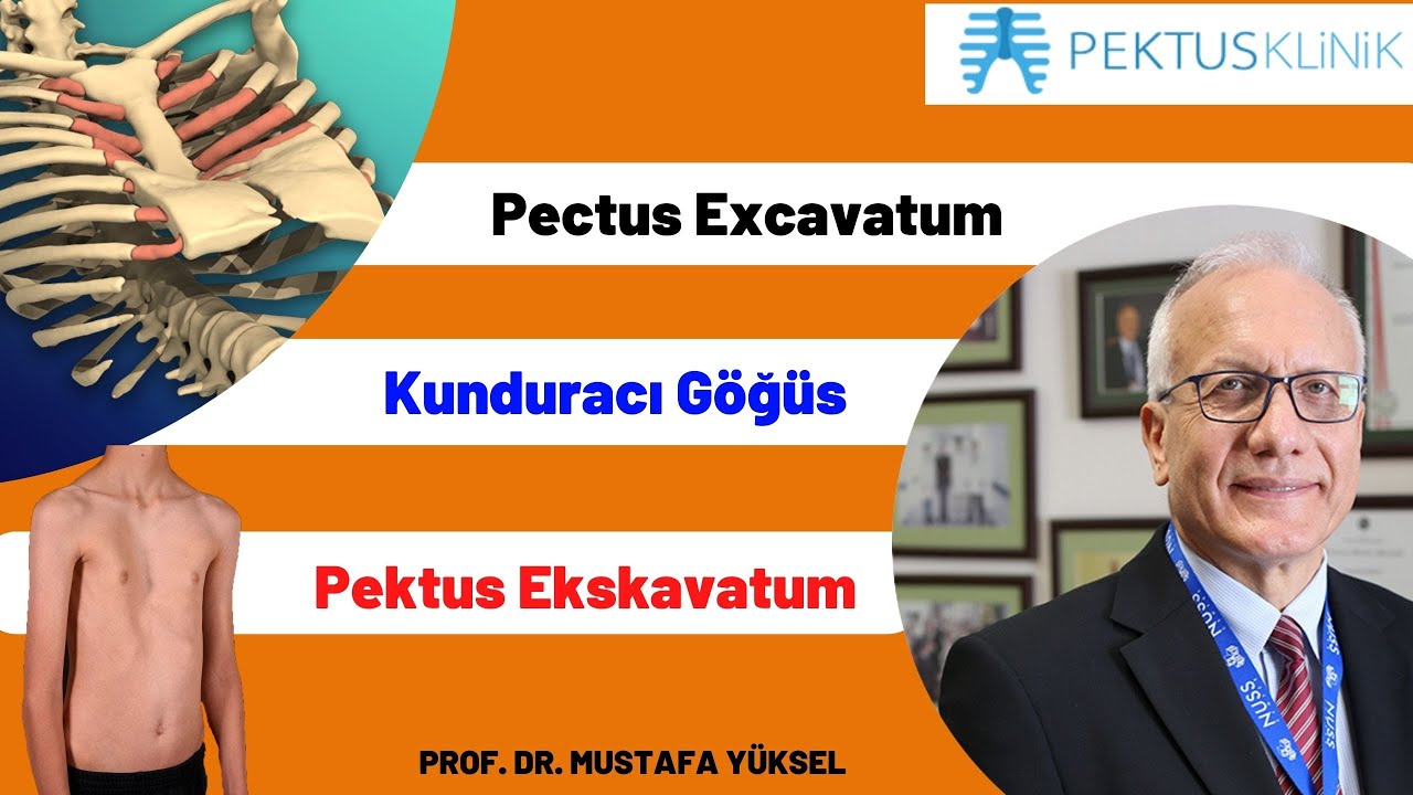 Dr. Mustafa Yüksel (PEKTUS EKSKAVATUMDA VAKUM BELL TEDAVİSİ)  2014