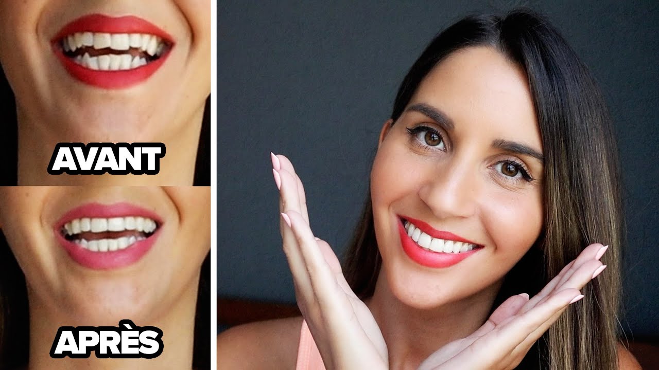 TRAITEMENT INVISALIGN : MES RÉSULTATS INCROYABLES EN SEULEMENT 3 MOIS ( + coût et fonctionnement)