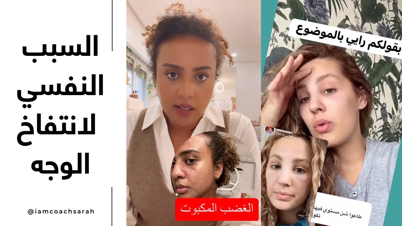 بعد ما حدث لوجه اسيا الشمري | كيف يؤثر الغضب المكبوت على اجسادنا | قصتي مع انتفاخ وجهي