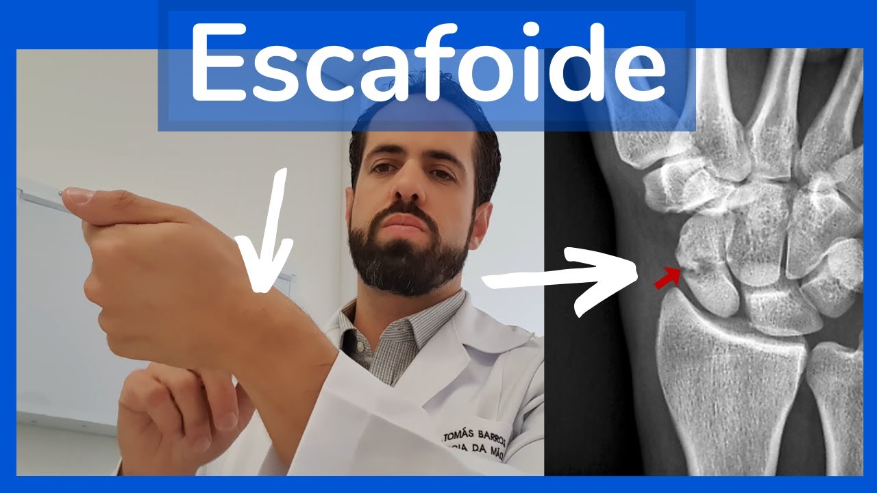 Tratamento do Escafoide -  Gesso ou Cirurgia?