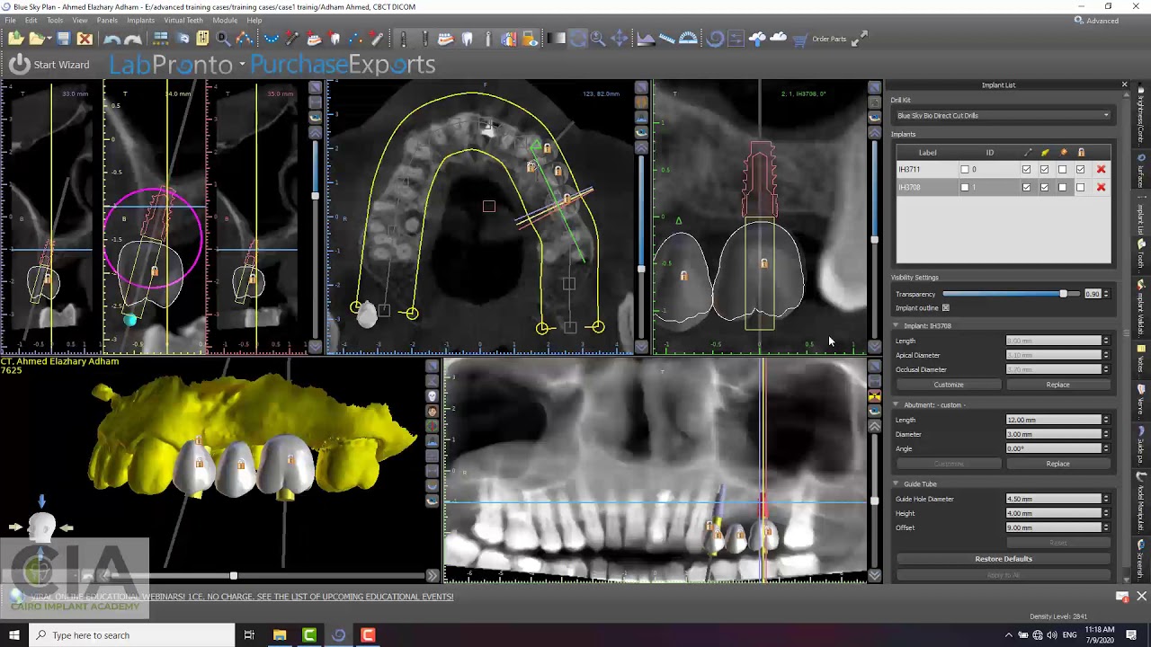 Bluesky arabic tutorial:105implant plan2