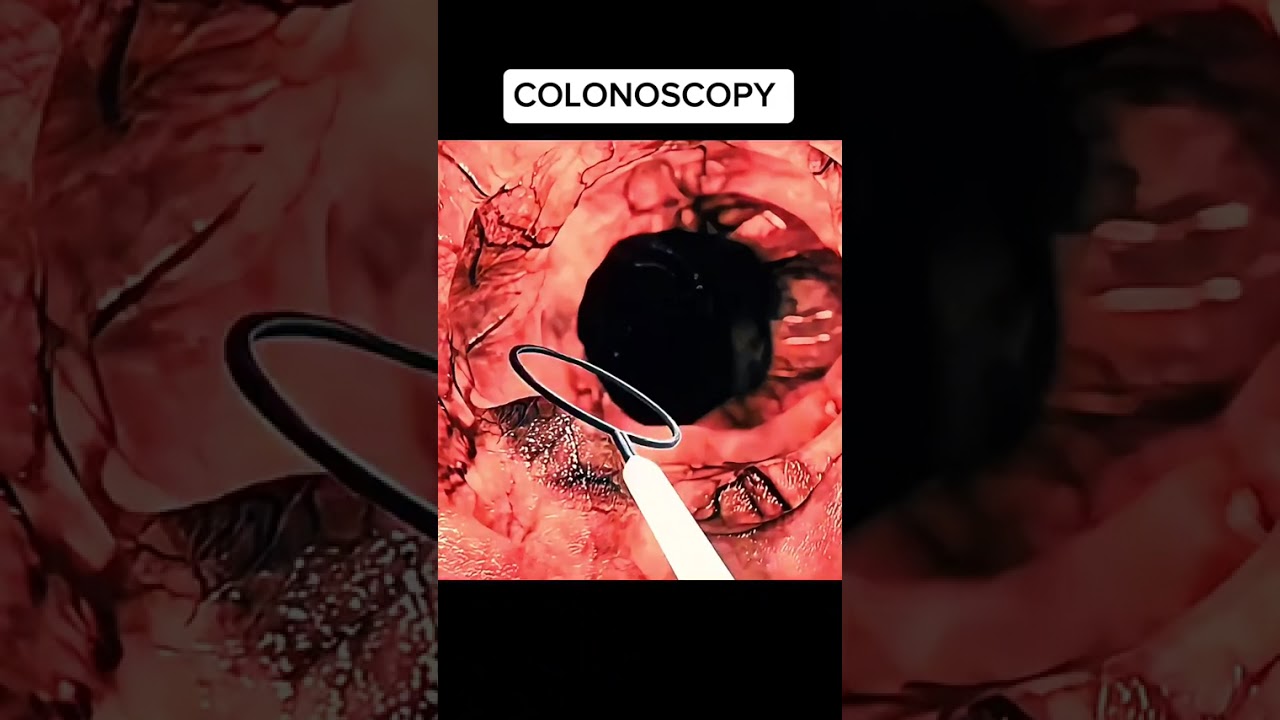 colonoscopy 3d  #Colonoscopy #ColonoscopyAwareness #ColonCancerScreening #MedTok #SurgicalProcedure