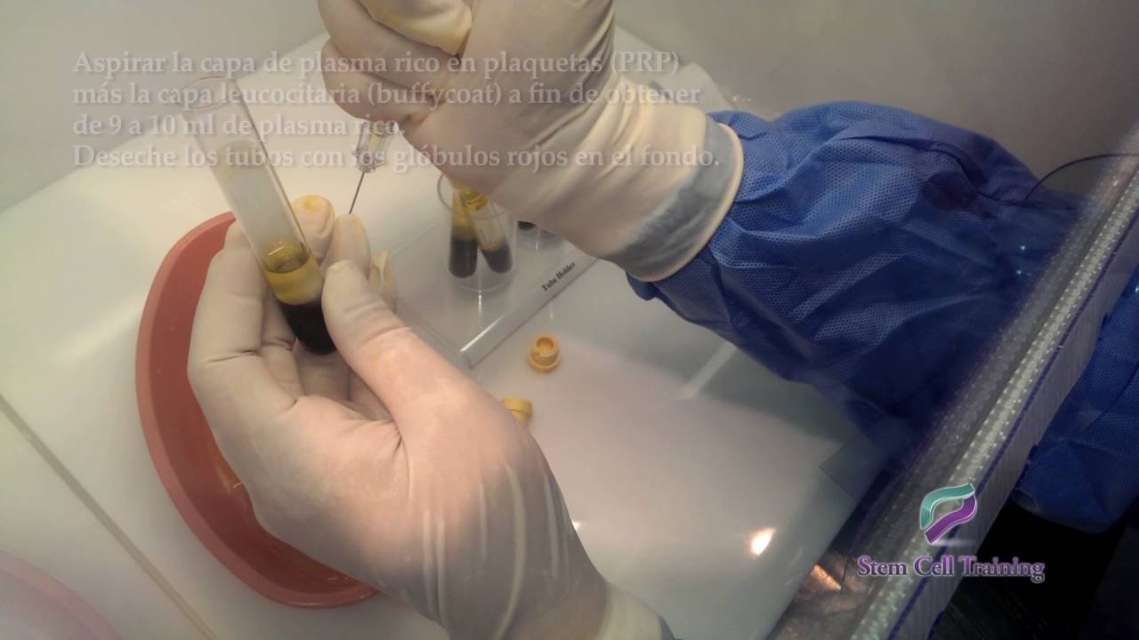 Protocolo de Plasma Rico Factores de crecimiento