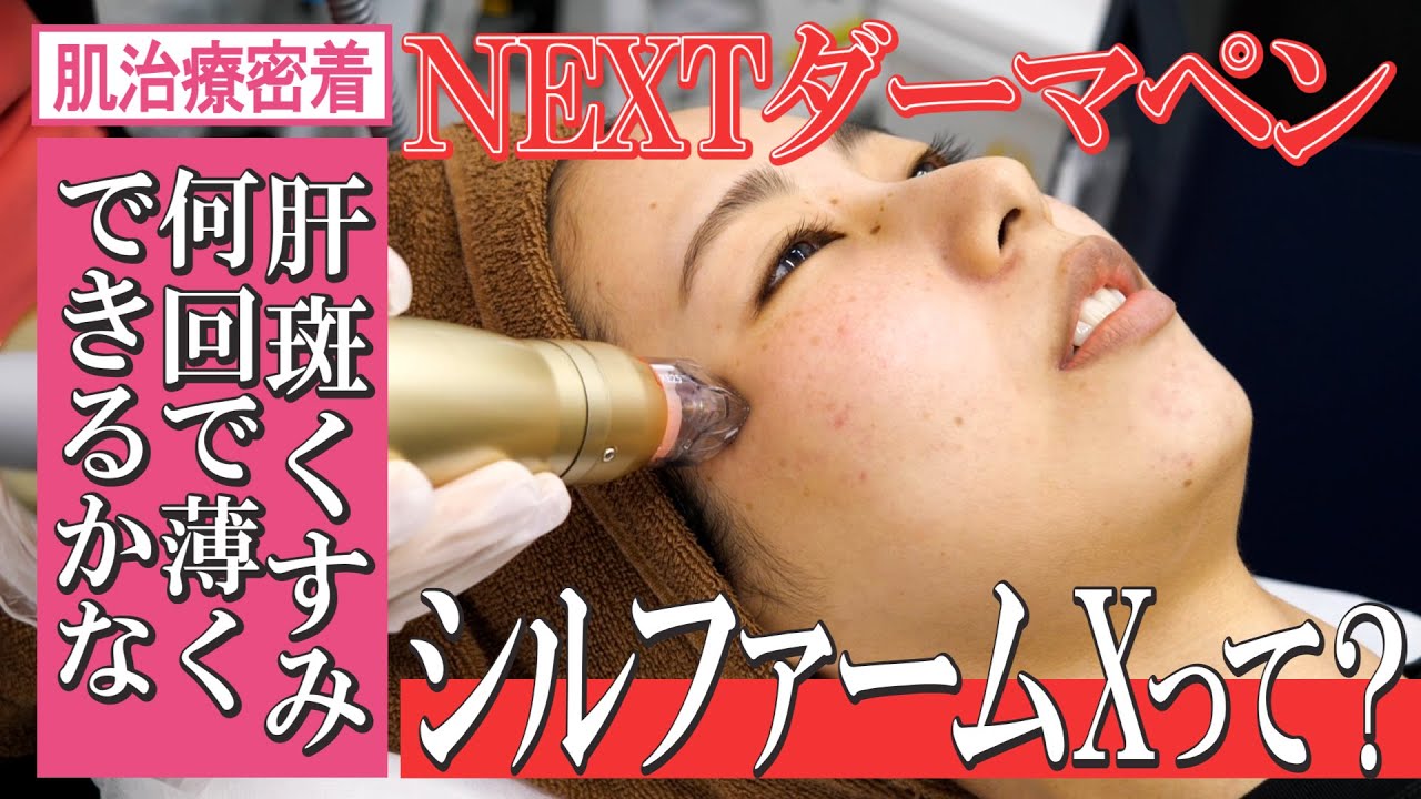 【もやもやシミの肝斑消し】シルファームXという針を顔に刺す治療を5回やってみた結果【ダーマペンみたいだけどさらに進化してます。毛穴やニキビ痕お悩みの方にも】湘南美容クリニック