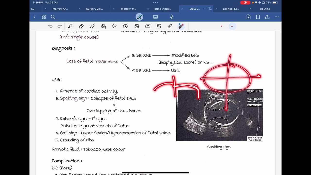 basics of pregnancy term Preterm delivery and intrauterine death