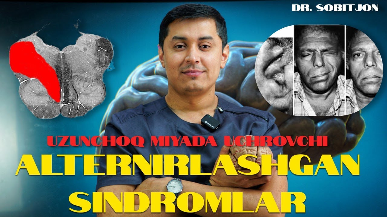 Uzunchoq miyada yuzaga keluvchi alternerlashgan sindromlar