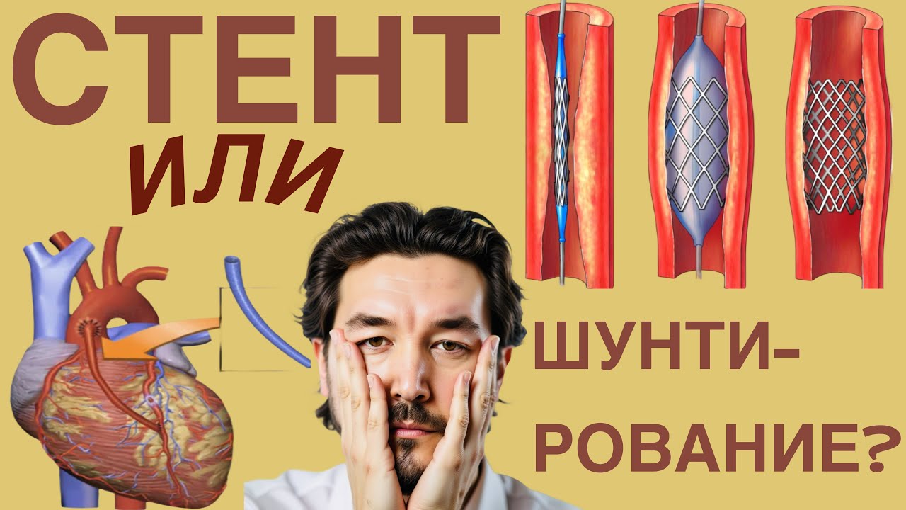 Стент или Шунтирование???#стент #стентирование #шунтирование #акш