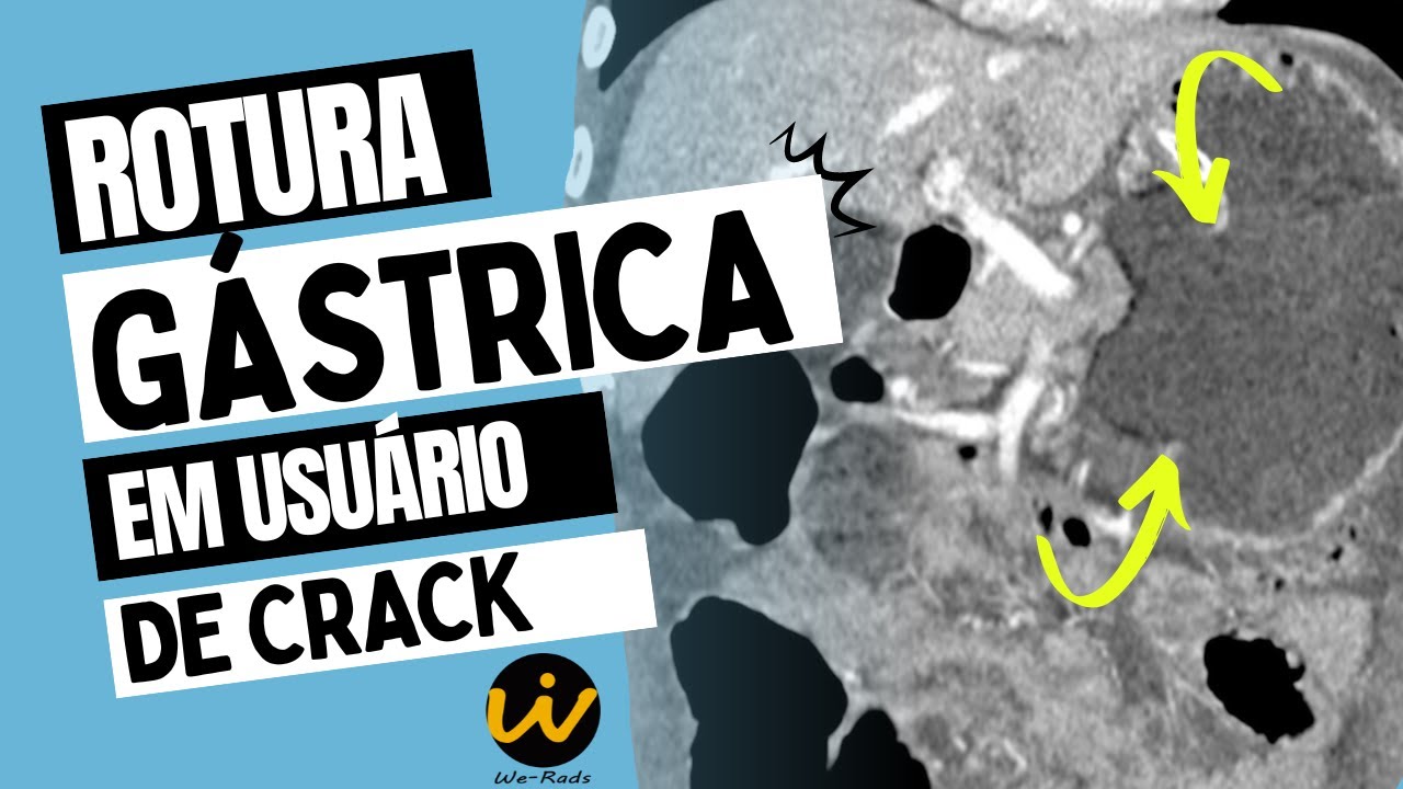 ROTURA GÁSTRICA em USUÁRIO de CRACK na Tomografia Computadorizada de Abdome