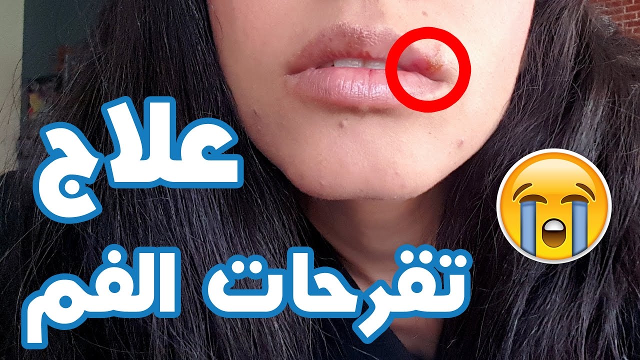 سيما مريضة!علاج تقرحات الفم