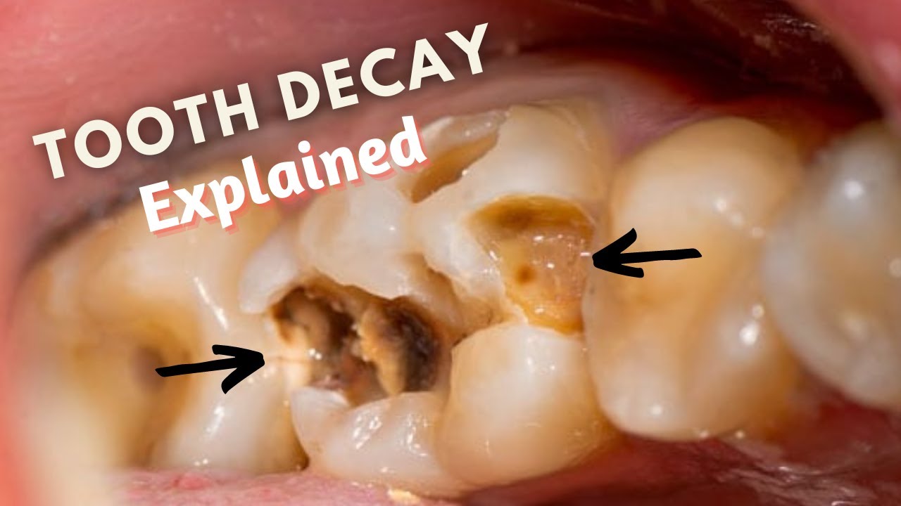 What Causes TOOTH DECAY? | Know How CAVITIES Develop!