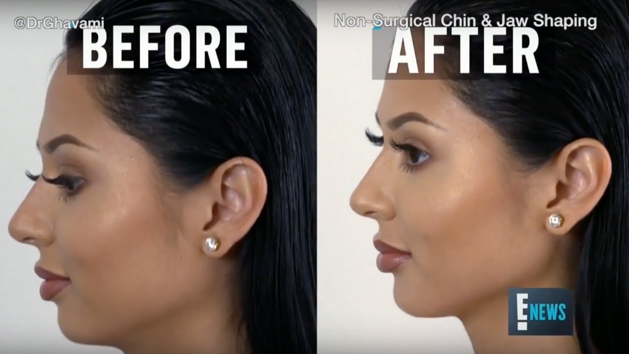 Non-Surgical Chin Augmentation by Dr. Ghavami | E News