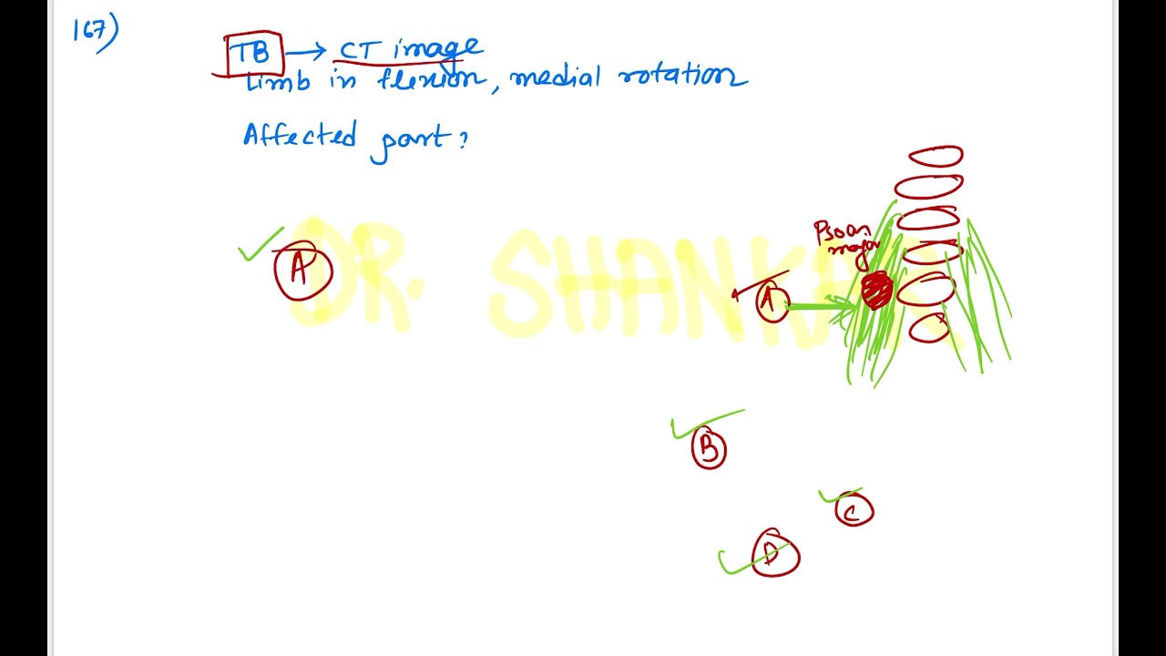 NEET-PG 2021 Recall Questions || Questions No. 161 to 180 || Dr. Shankar Dey