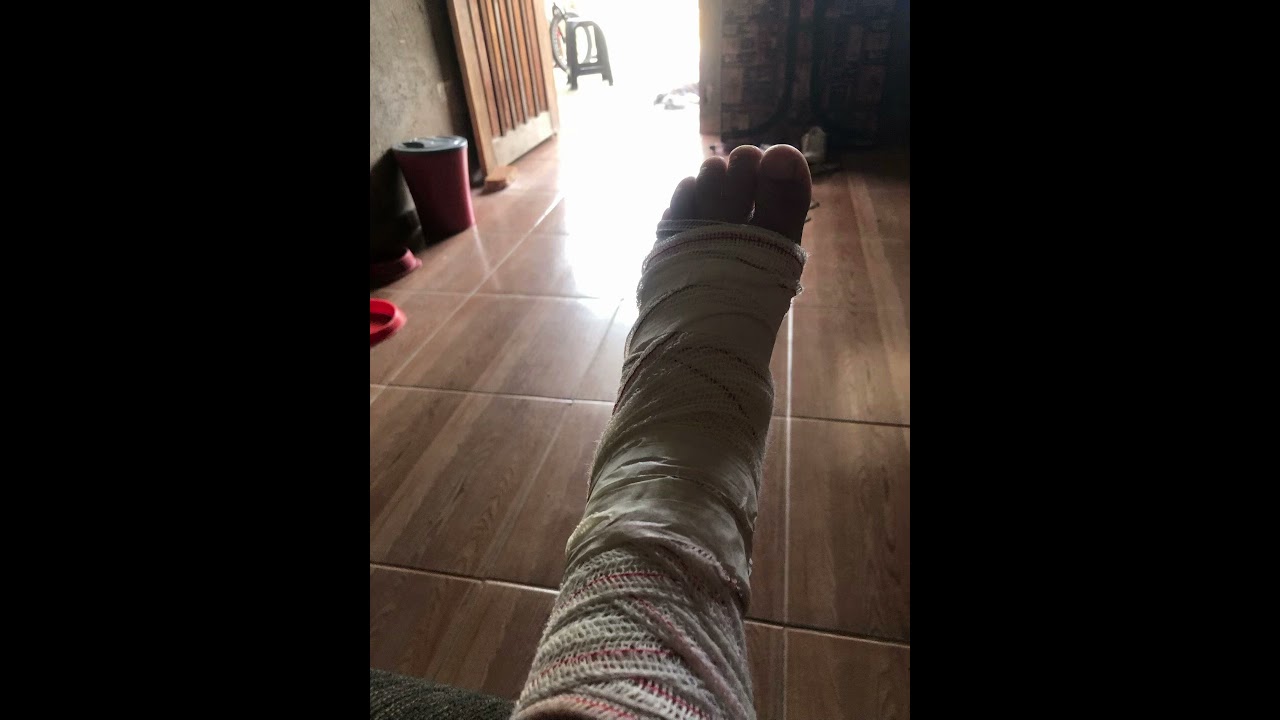 Fiz uma contusão no pé e não consigo encostar o meu pé esquerdo no chão e e agora tou repousando