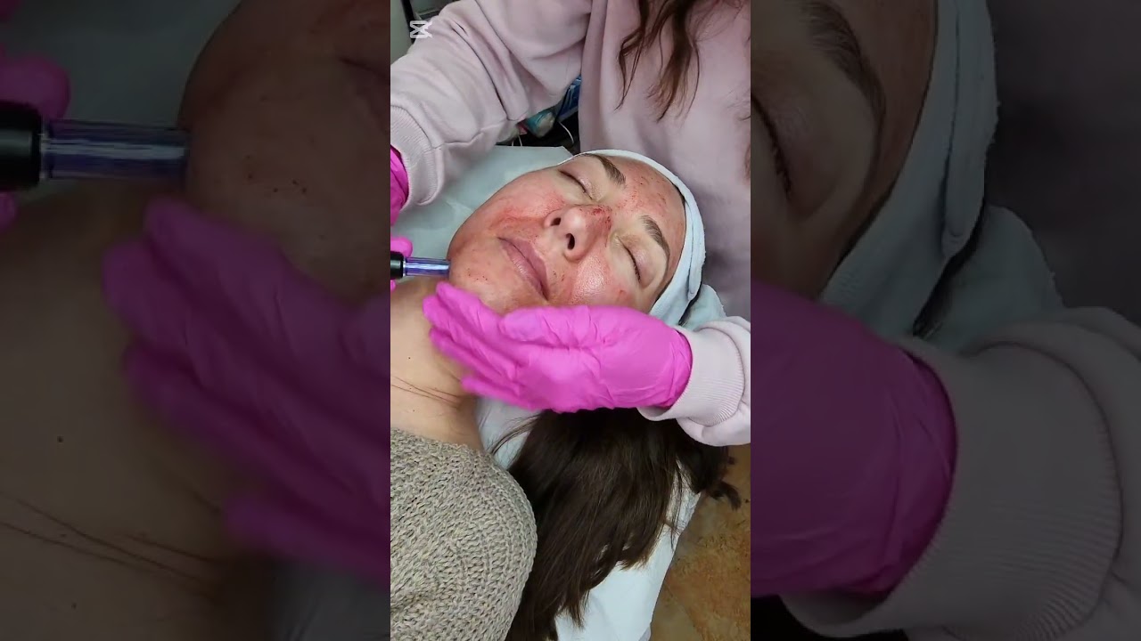 Процедура за лице: Микронидлинг
