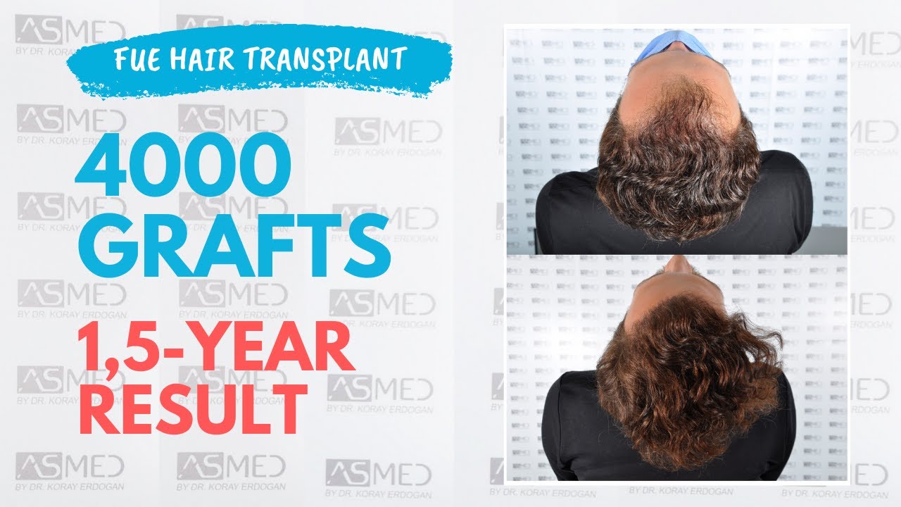 Manual FUE Hair Transplant Before & After 4000 Grafts 1.5-Year Result - ASMED - Dr. Koray Erdogan