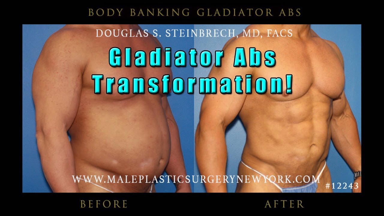 Gladiator Abs body implants for men in NYC