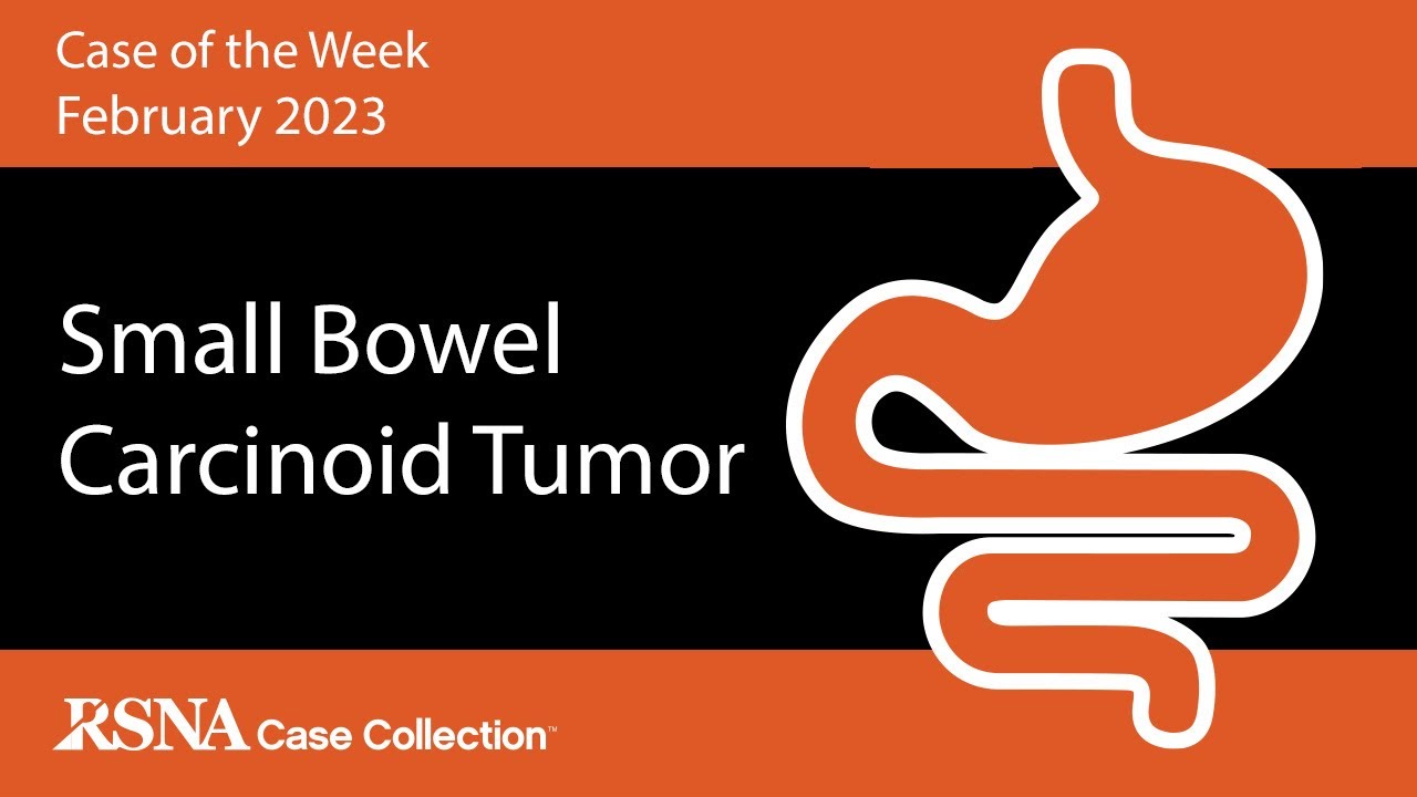 Case of the Week: Small Bowel Carcinoid Tumor