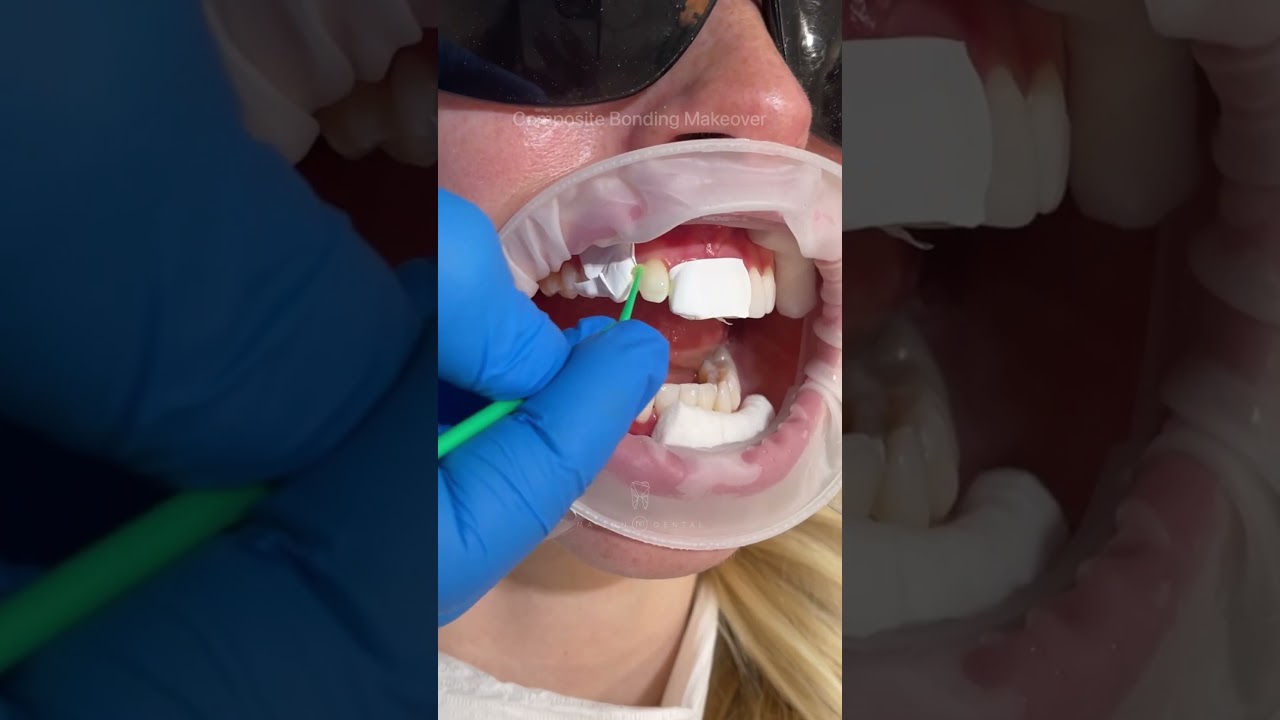 Composite Bonding Makeover ✨ 8 teeth treated 🤍