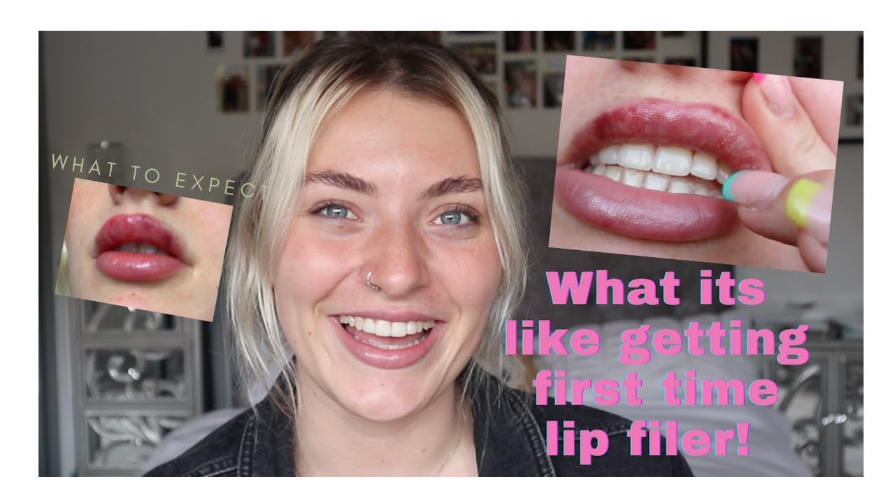 WHAT ITS LIKE GETTING FIRST TIME LIP FILLER